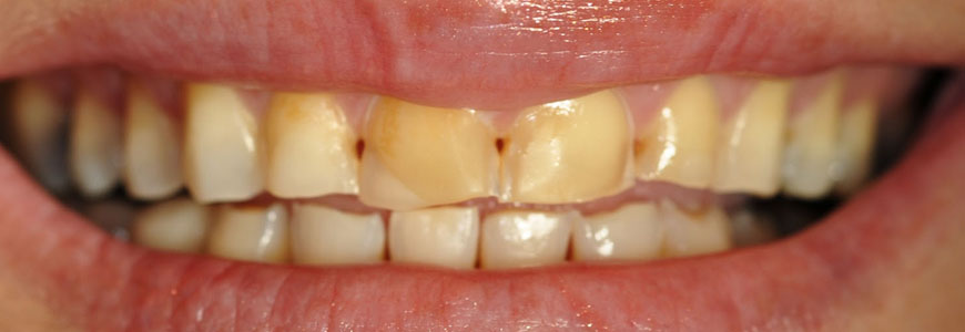 Dental Fluorosis