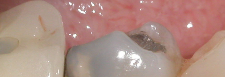 Tooth Discoloration